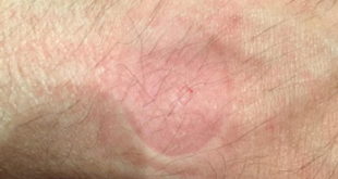 1 apple watch wrist burn webjpg Apple Watch wearers share 'burn' images on social media